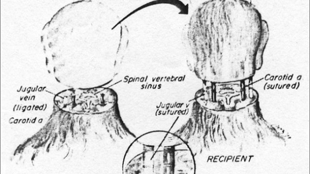头部移植 - 我们2