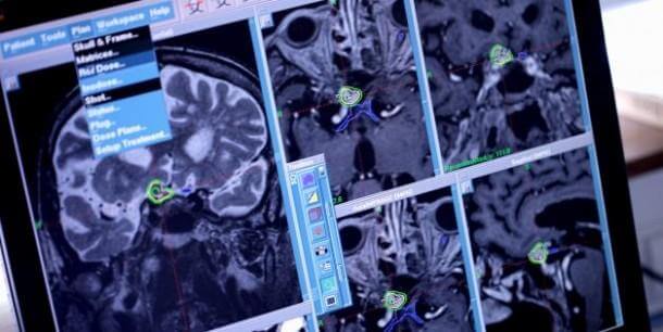 头部移植 - 我们有多远3