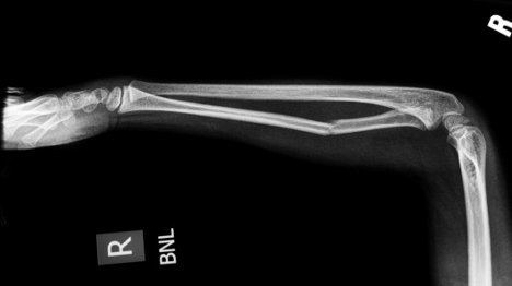 骨愈合裂缝果皮