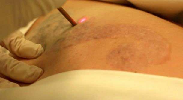 用现代激光技术去除纹身爱游戏ayx体育