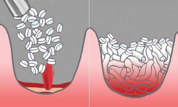 XSTAT_SYRINGE（1）