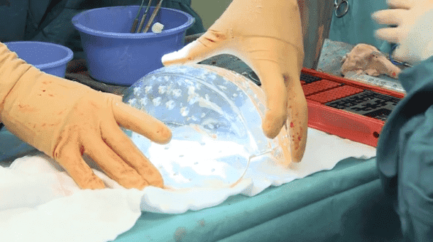 3D印刷颅植入物2