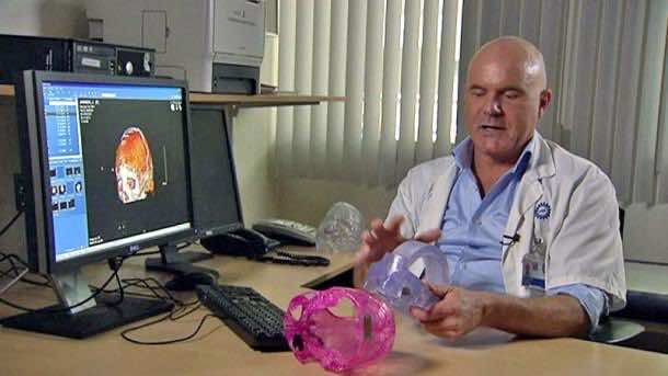 3D打印的颅内植入物