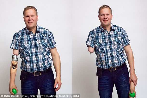 精神控制的假肢赋予触觉