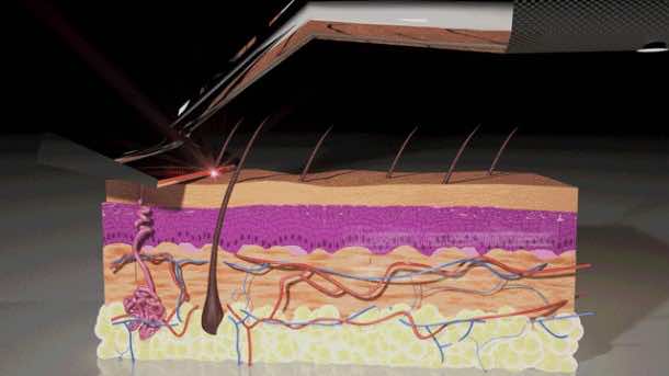 Skarp Razor使用激光剃须3