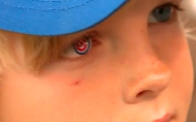 癌症幸存者假眼