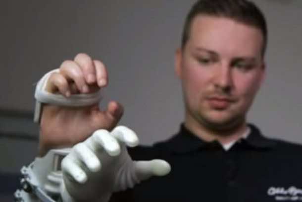 在决定手术之前，米洛用的是混血手。学分:bbc.com