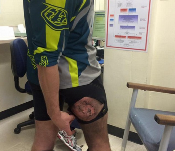 据称，一台iPhone在他的裤子里爆炸，并在他的屁股上燃烧了三度