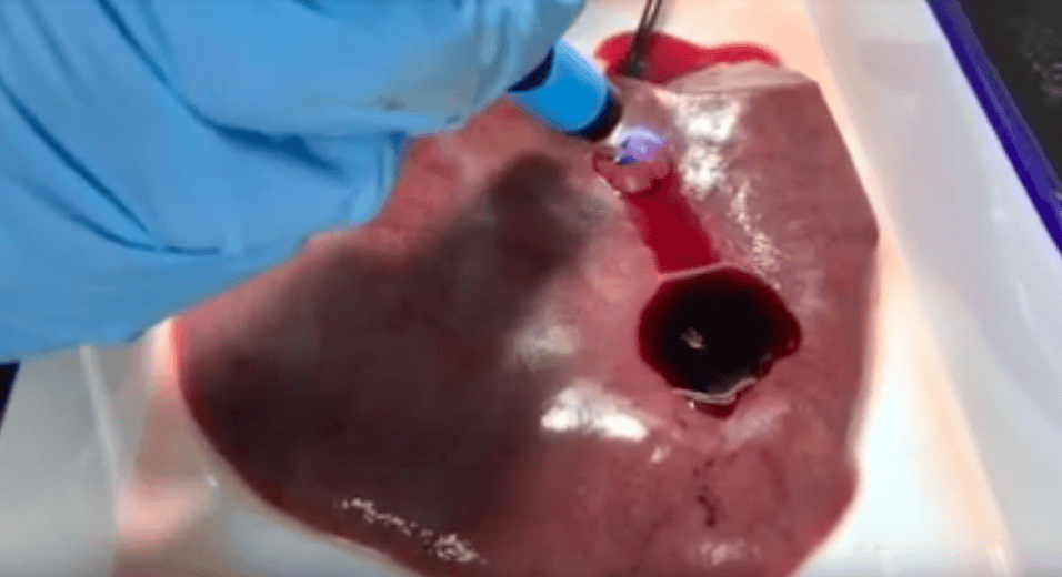 基质凝胶是一种能够阻止创伤后出血的生物胶